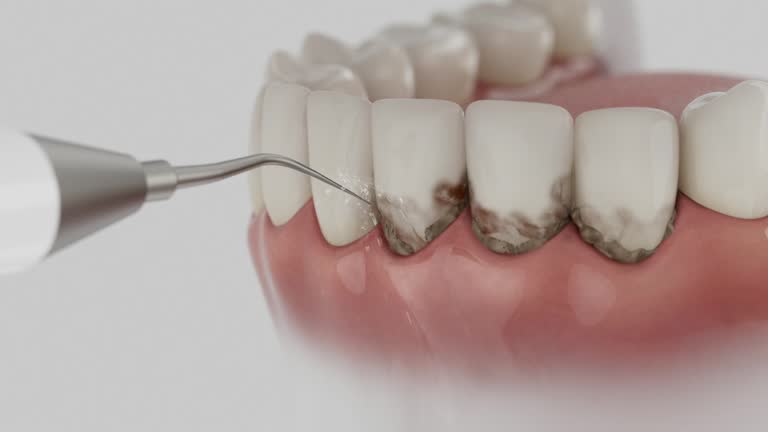 Reliable Tooth Extraction contractor in Burlington, ND by Smile Center Dentistry